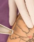 Combien de séances laser faut-il pour effacer un tatouage ?