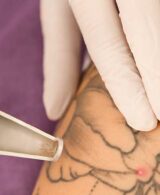 Combien de séances laser faut-il pour effacer un tatouage ?