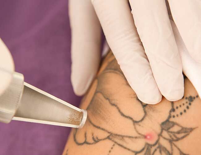 Combien de séances laser faut-il pour effacer un tatouage ?