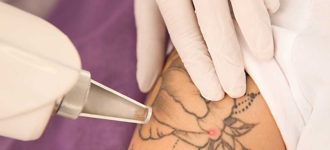 Combien de séances laser faut-il pour effacer un tatouage ?